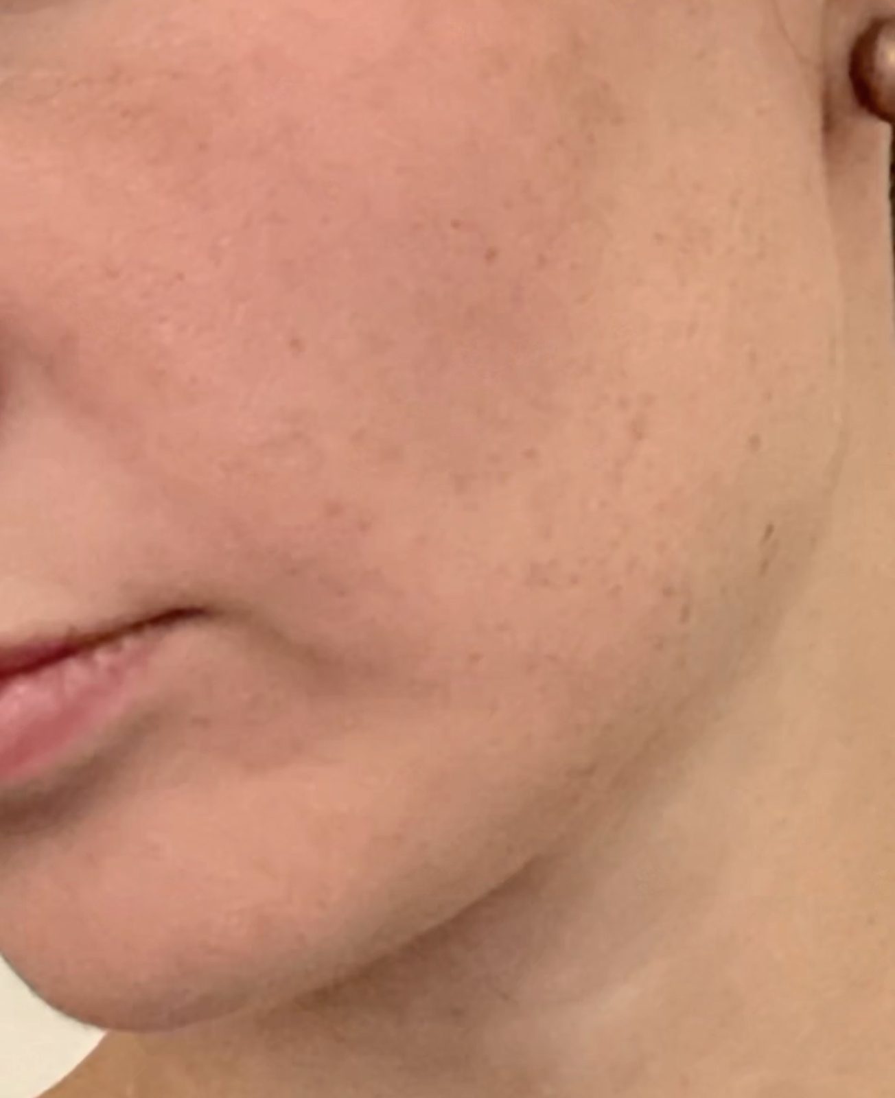 Acne after
