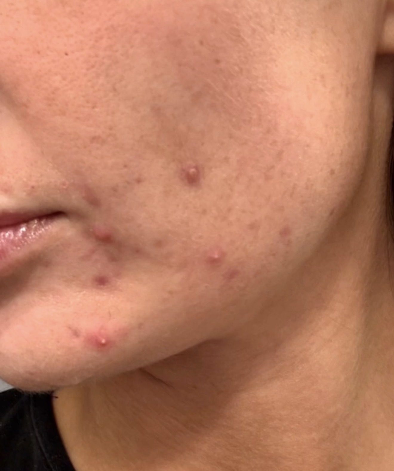 Acne before