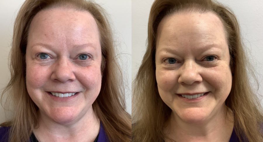 Eczema before and after