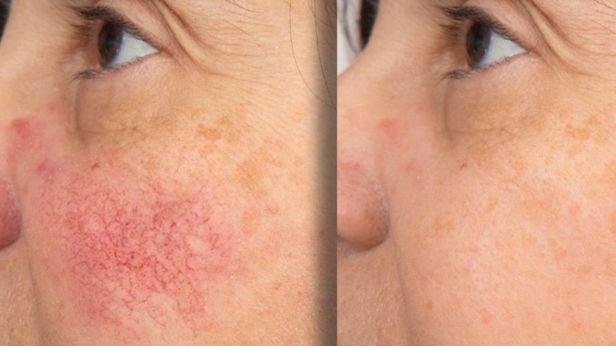 Rosacea before and after