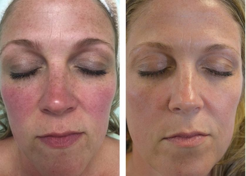 Rosacea before and after